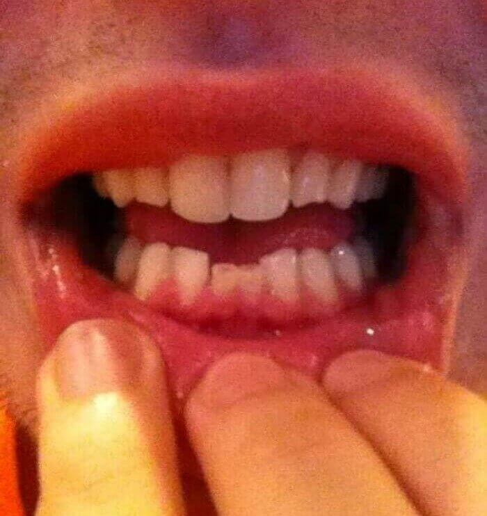 Baby Teeth At 21