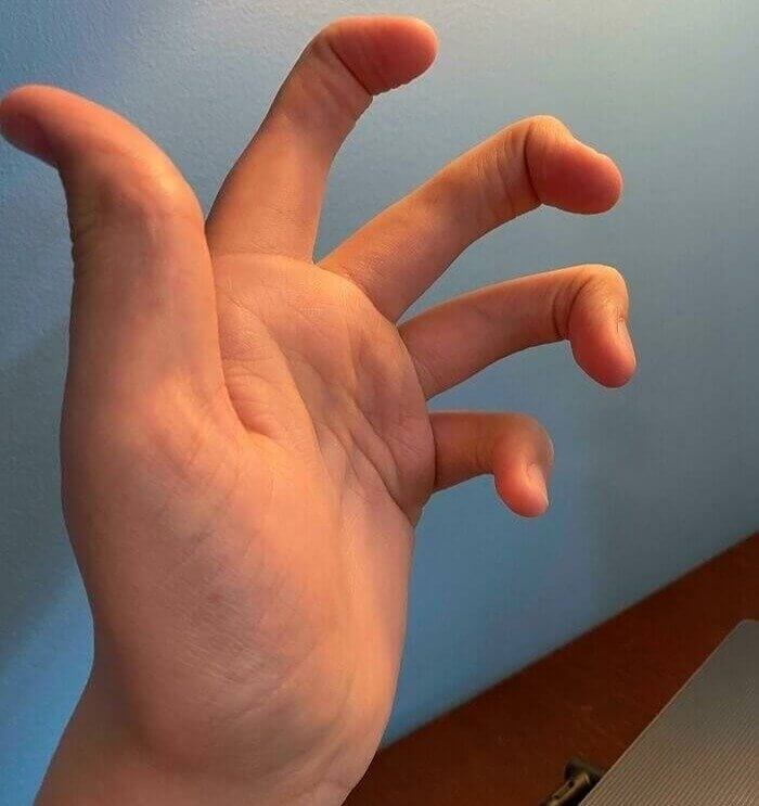 This Person With No Middle Joints In Their Fingers