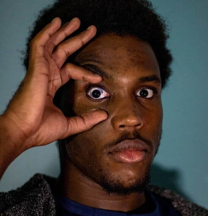 A Guy With A Birthmark On His Eye