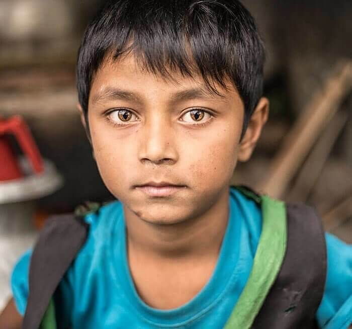 A Boy Who Was Born With Cat-Eye Syndrome