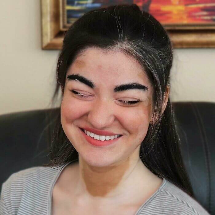 Vitiligo Caused Half Of Her Eyelashes To Turn White