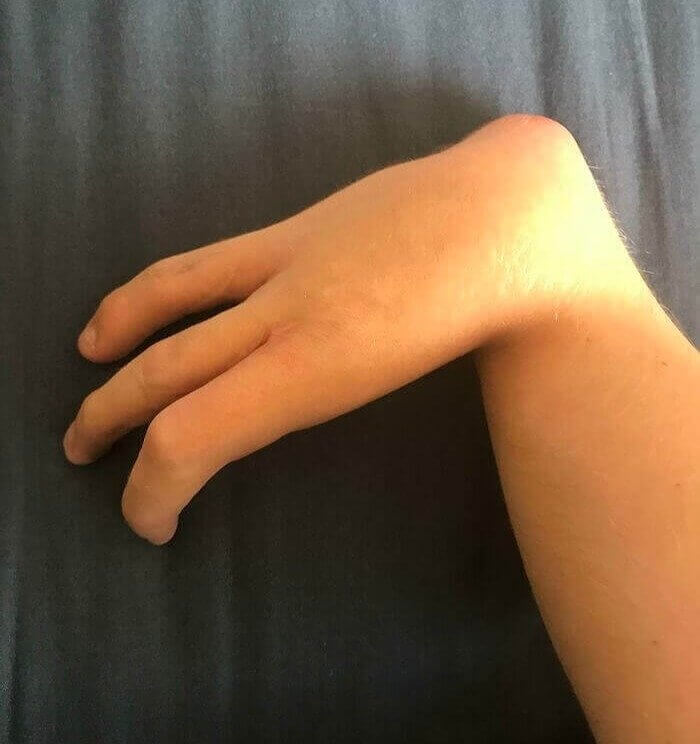 This Person Was Born With Three Fingers