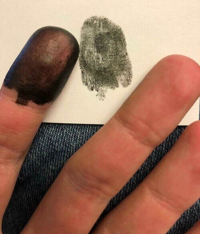 Born With No Fingerprints