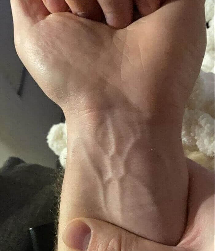 A Person With A Unique Hexagon Vein On Their Wrist