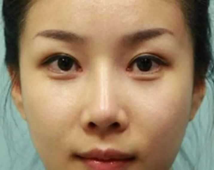 Thin Noses - South Korea