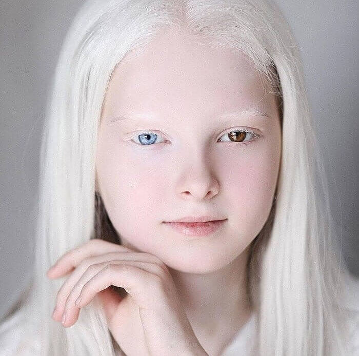 This Girl Has Both Albinism And Heterochromia