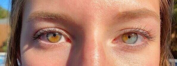 Born With Partial Heterochromia