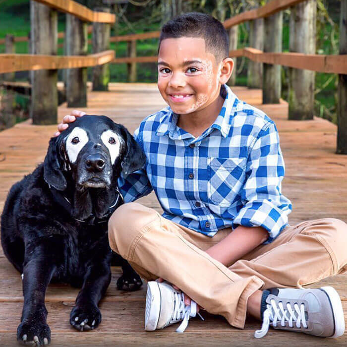 Both Of These Best Buddies Have Vitiligo