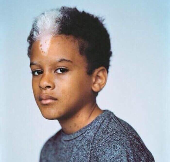 This Boy Who Was Born With An Unforgettable Birth Mark