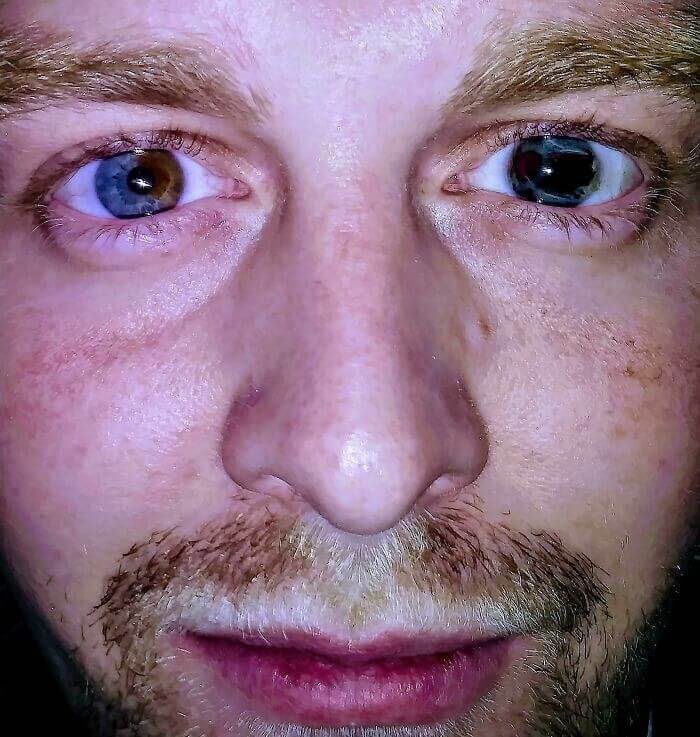 An Interesting Eye Condition