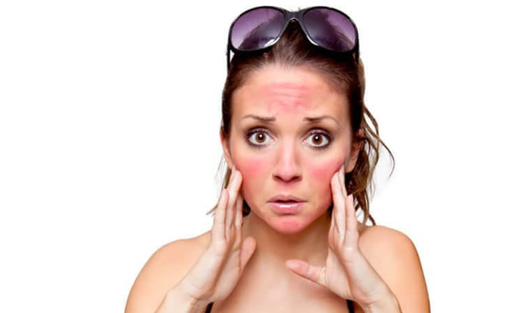 Sun Exposure Heals Acne